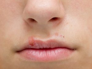 Remédios naturais para tratar a herpes labial Remédios naturais para tratar a herpes labial