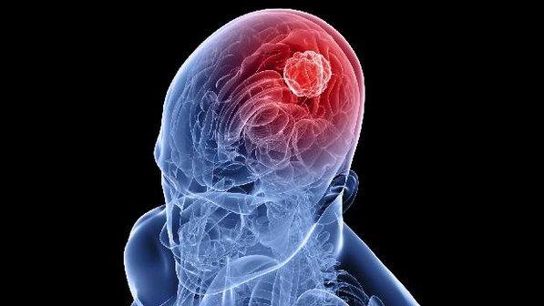 Alguns sintomas de um Tumor Cerebral