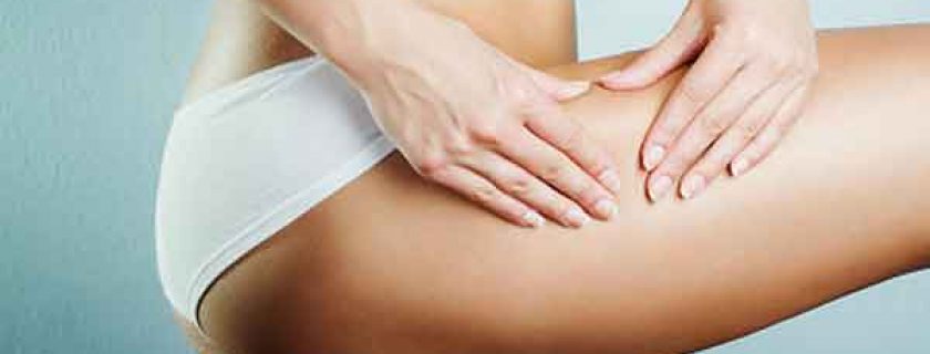 Dicas para prevenir as estrias