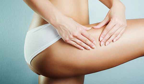 Dicas para prevenir as estrias Dicas para prevenir as estrias
