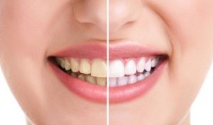 como clarear os dentes de forma rápida