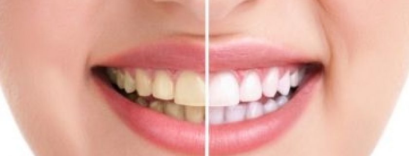 Como clarear os dentes de forma rápida