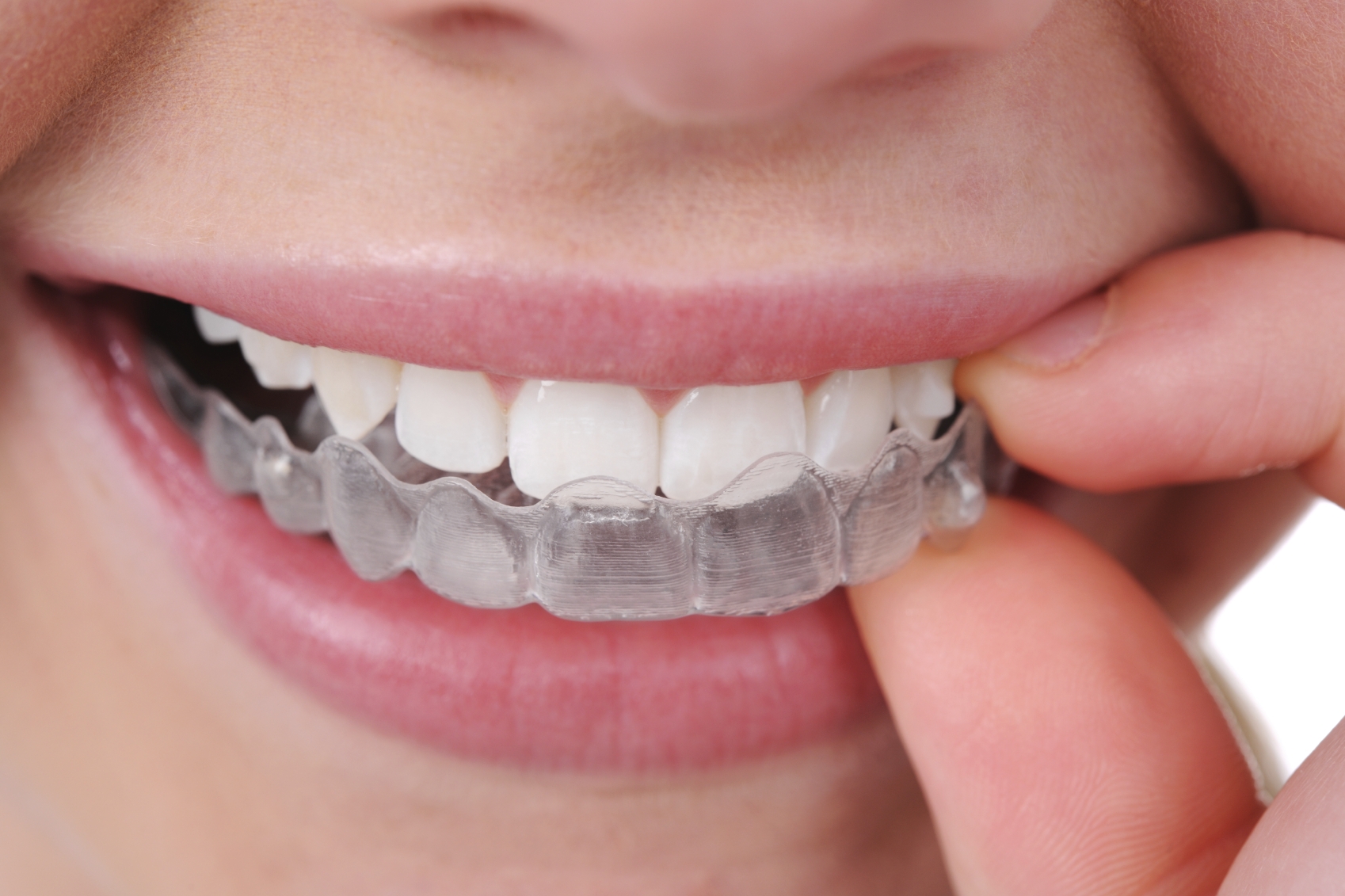 Como alinhar os dentes sem aparelhos