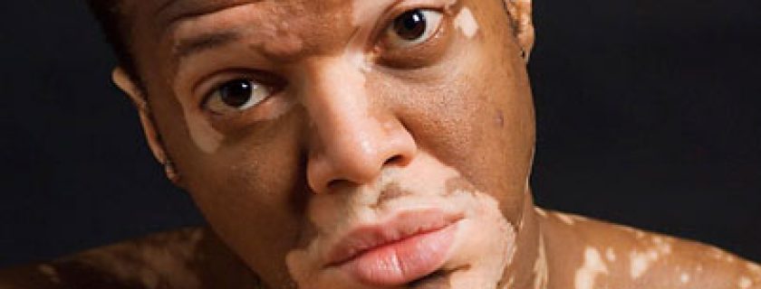 Remédios naturais para Vitiligo