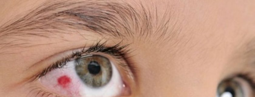 Pontos a considerar sobre os derrames oculares