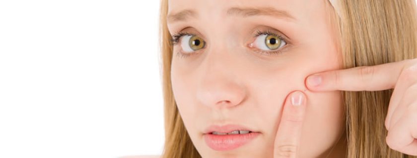 Dicas para evitar que sua pele se torne propensa à acne