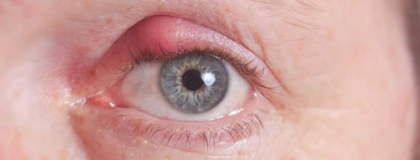Terçol: o que é, como tratar e prevenir