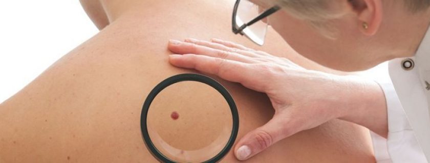 Como identificar o câncer de pele