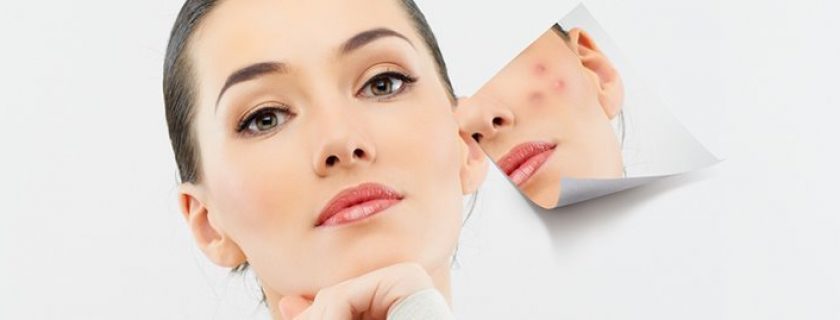 Remédios caseiros para cicatrizes de acne
