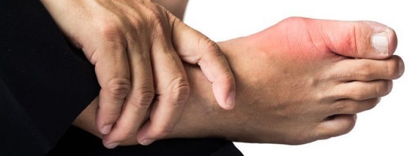 Dicas eficazes e remédios caseiros para tratar a gota