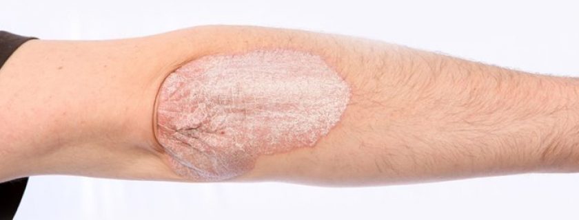 7 melhores remédios caseiros para psoríase