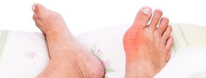 7 incríveis alimentos que ajudam a combater a gota naturalmente