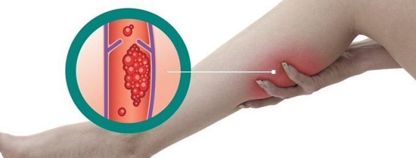 7 melhores remédios caseiros para trombose venosa profunda