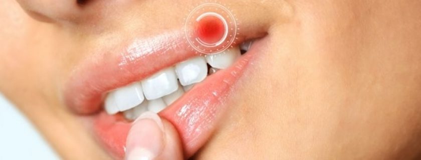 O que é o herpes e como tratá-lo em diferentes áreas do corpo