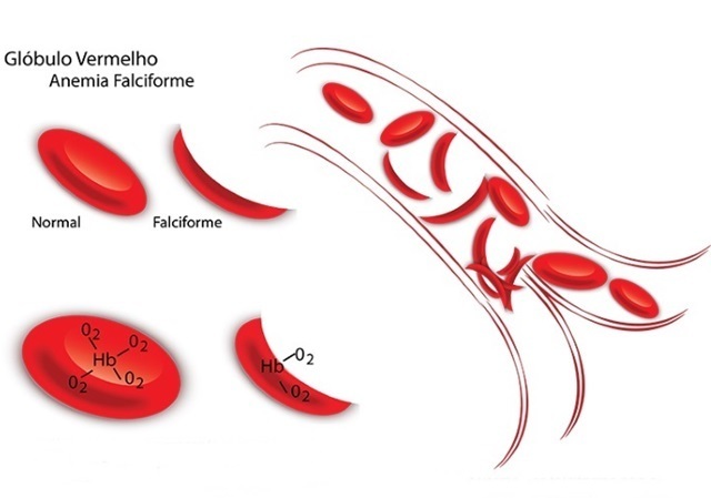 O Que Anemia Falciforme Quais Seus Sintomas E Tratamentos