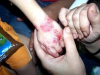 Conheça a rara doença Epidermólise bolhosa