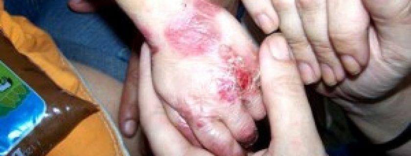 Conheça a rara doença Epidermólise bolhosa