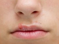 Remédios naturais para tratar a herpes labial