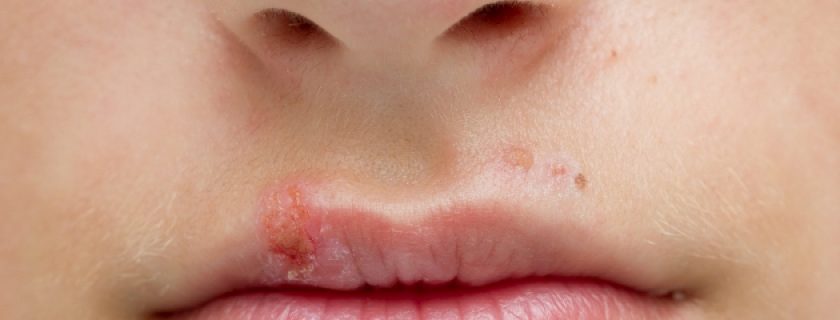 Remédios naturais para tratar a herpes labial