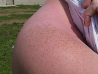 Remédios caseiros contra queimaduras