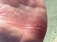 Produtos caseiros para ajudar a curar queimaduras de 1º grau