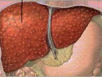 Doença hepática, sintomas e recomendações