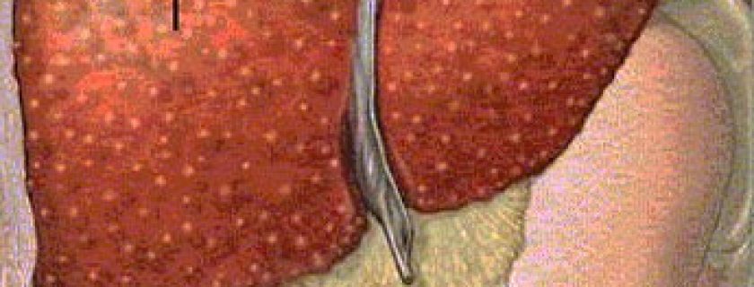 Doença hepática, sintomas e recomendações