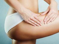 Dicas para prevenir as estrias