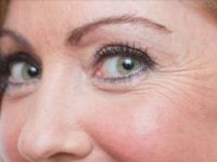 Como evitar os pés de galinha