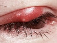 Remédios caseiros para curar o terçol