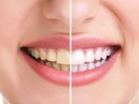 Como clarear os dentes de forma rápida
