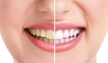 Como clarear os dentes de forma rápida