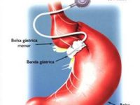 40% das pessoas que se submetem à cirurgia de redução de peso sofrem complicações