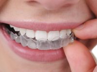 Como alinhar os dentes sem aparelhos