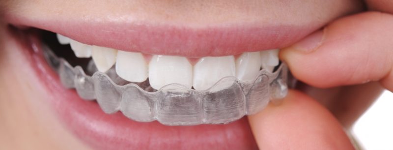 Como alinhar os dentes sem aparelhos