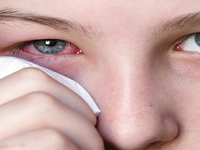 Homeopatia para o tratamento de conjuntivite alérgica