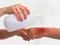 O que fazer se você se queimar na cozinha?