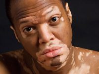 Remédios naturais para Vitiligo