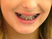 Conselhos odontológicos para quem usa aparelho