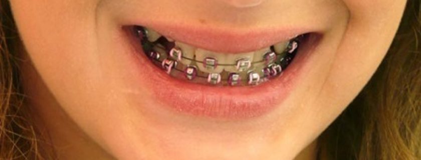 Conselhos odontológicos para quem usa aparelho