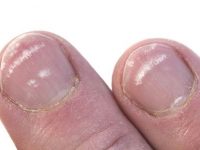 O que são as manchas brancas sobre as unhas?
