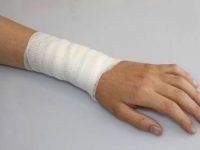 Remédios caseiros para combater queimaduras leves