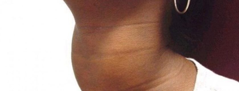 Tireóide: Hipertireoidismo e hipotireoidismo