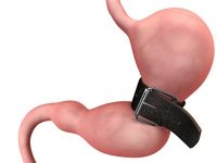 A cirurgia não é a solução mais fácil para a obesidade