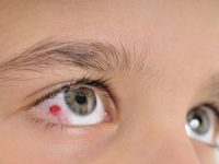 Pontos a considerar sobre os derrames oculares