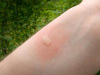 Luta contra mosquitos: como evitar e tratar picadas
