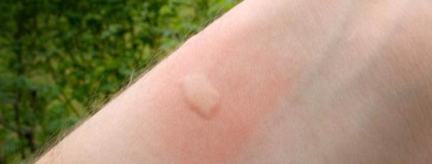 Luta contra mosquitos: como evitar e tratar picadas