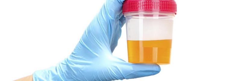 5 diferentes cores de urina e o que dizem sobre sua saúde