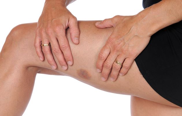 6 remédios caseiros eficazes para tratar hematomas