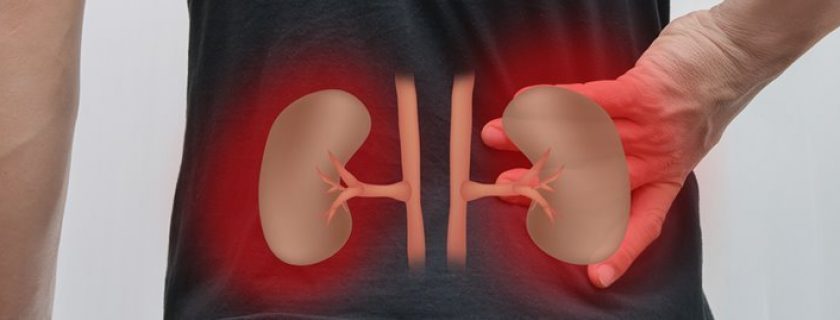 Cálculo renal: tipos, sintomas e dieta para prevenir